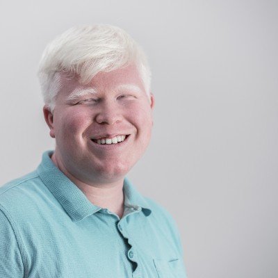 Man with albinism smiling into camera 